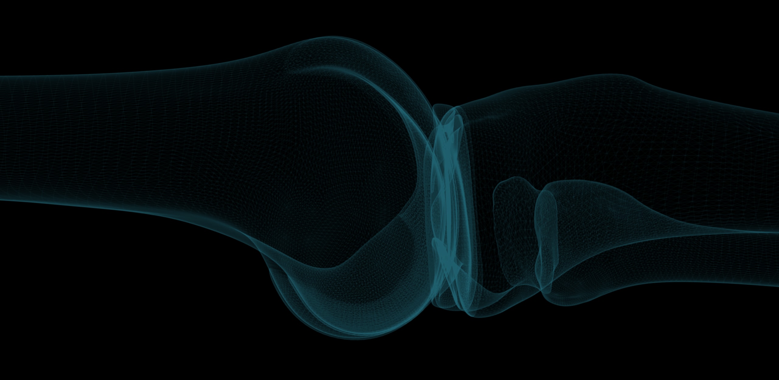 X-ray image of a knee joint illustrating cartilage degeneration.